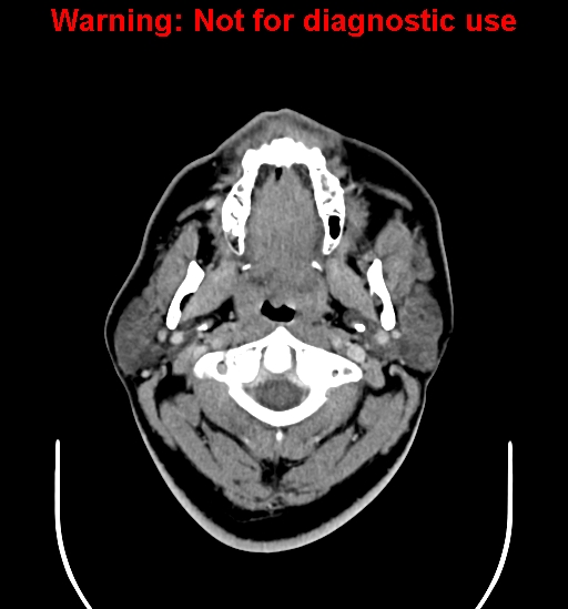 File:Ameloblastoma (Radiopaedia 33126-34164 B 1).jpg