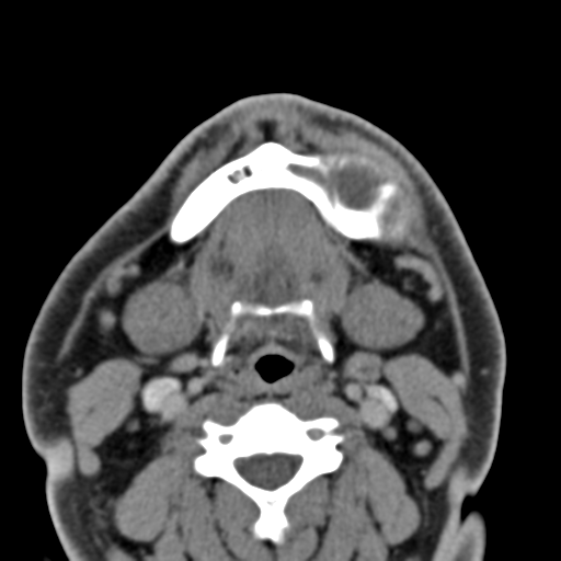 File:Ameloblastoma (Radiopaedia 33677-34806 Axial non-contrast 30).png