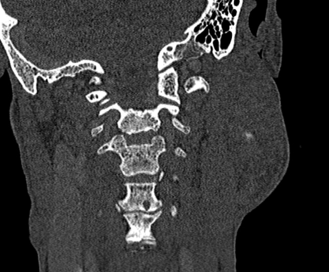 Ameloblastoma (Radiopaedia 51921-57766 Coronal bone window 237).jpg