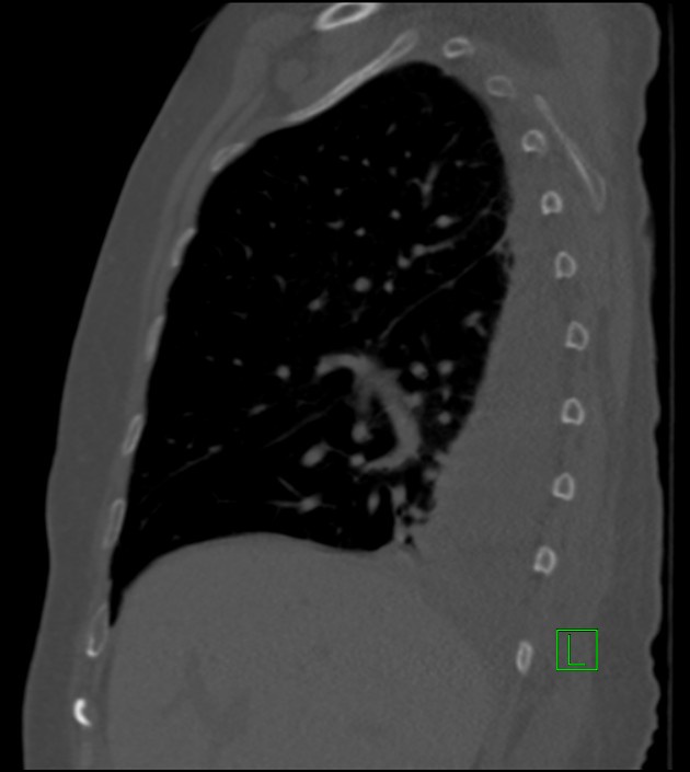 Amiodarone deposition in the liver (Radiopaedia 77587-89780 Sagittal bone window 69).jpg