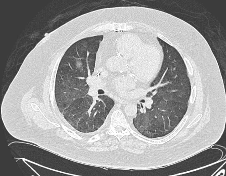 Amiodarone lung (Radiopaedia 62514-70769 Axial lung window 45).jpg
