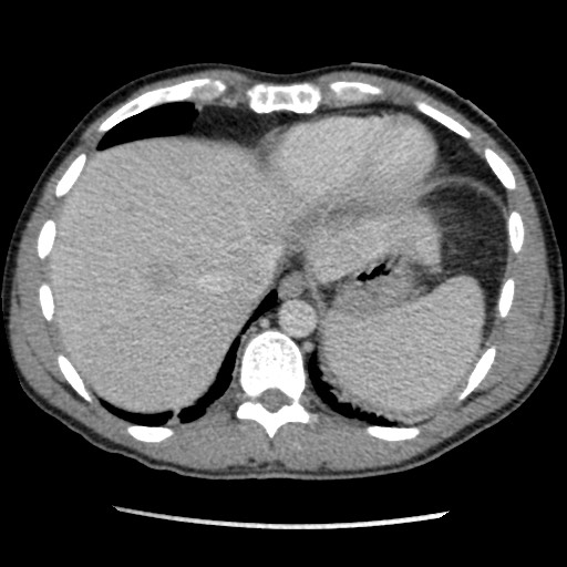 File:Amoebic liver abscesses (Radiopaedia 55536-62009 A 14).jpg