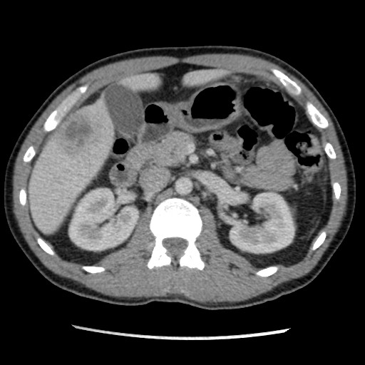 Amoebic liver abscesses (Radiopaedia 55536-62009 A 36).jpg