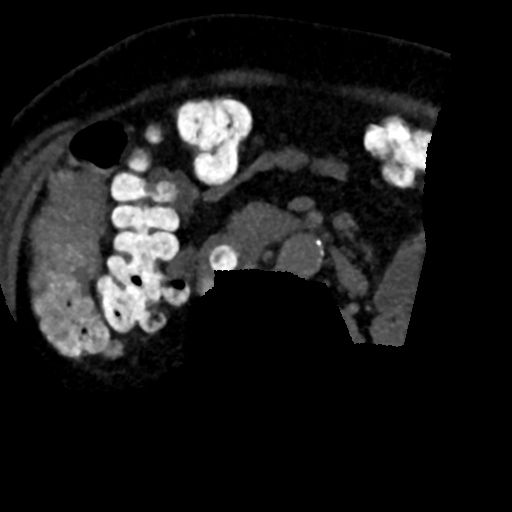Ampullary adenocarcinoma (Radiopaedia 34013-35241 AXIAL MIPS 3-1.5 91).png