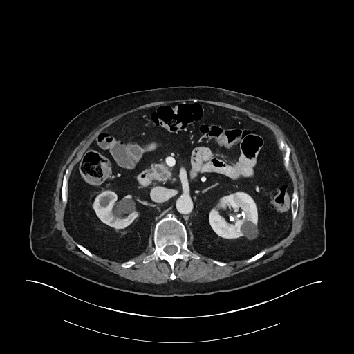 Ampullary adenocarcinoma (Radiopaedia 59373-66734 C 63).jpg