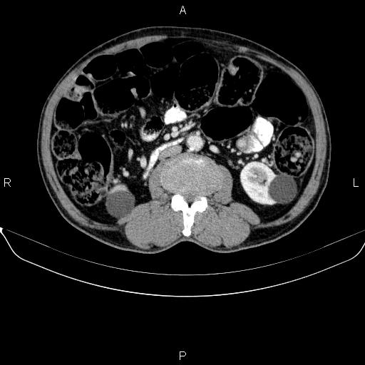 Ampullary adenocarcinoma (Radiopaedia 86093-102032 A 30).jpg