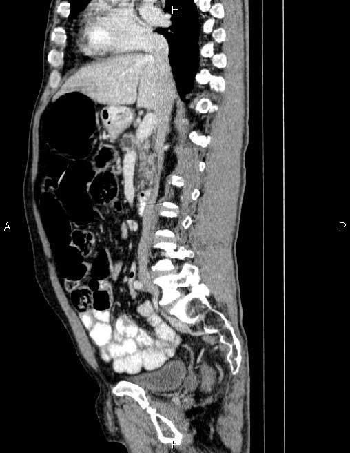Ampullary adenocarcinoma (Radiopaedia 86093-102032 D 41).jpg