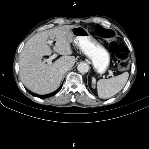 Ampullary adenocarcinoma (Radiopaedia 86093-102033 B 53).jpg