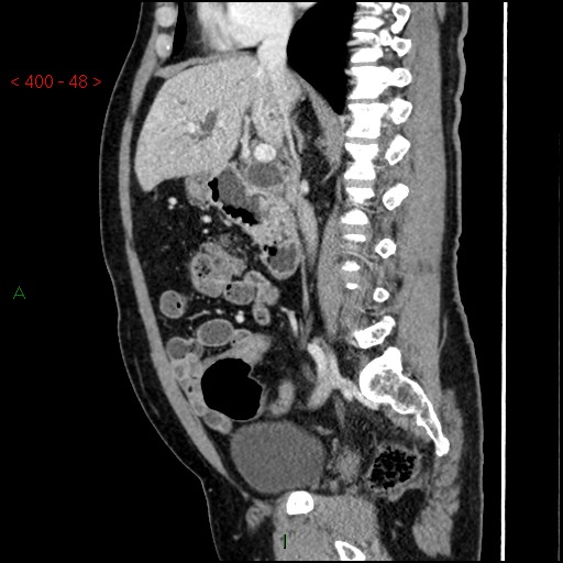 Ampullary carcinoma (Radiopaedia 56396-63056 D 47).jpg