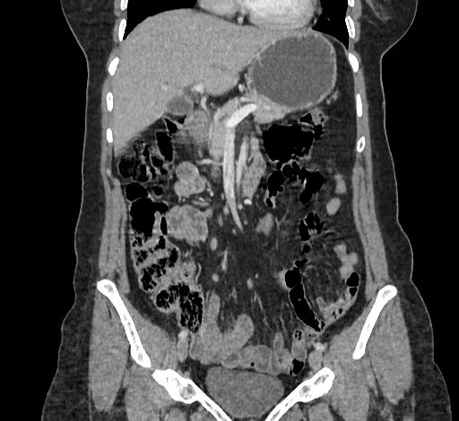 Ampullary tumor (Radiopaedia 60333-67998 B 30).jpg