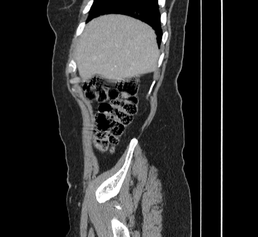 File:Ampullary tumor (Radiopaedia 60333-67998 C 6).jpg