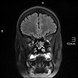 File:Amyotrophic lateral sclerosis (Radiopaedia 70821-81017 Coronal FLAIR 8).jpg