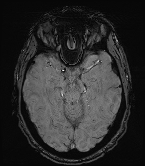 Amyotrophic lateral sclerosis (Radiopaedia 87352-103658 Axial SWI 20).jpg