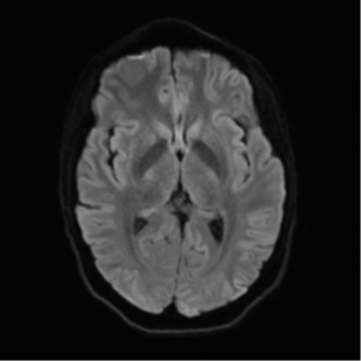 Anaplastic astrocytoma IDH mutant (Radiopaedia 50046-55341 Axial DWI 41).png