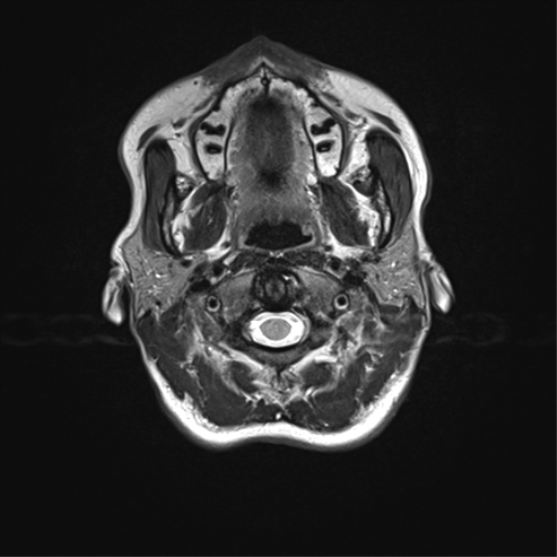 File:Anaplastic astrocytoma IDH mutant (Radiopaedia 50046-55341 Axial T2 1).png
