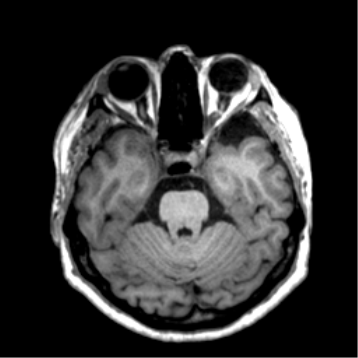 Anaplastic astrocytoma IDH wild-type (pseudoprogression) (Radiopaedia 42209-45277 Axial T1 43).png