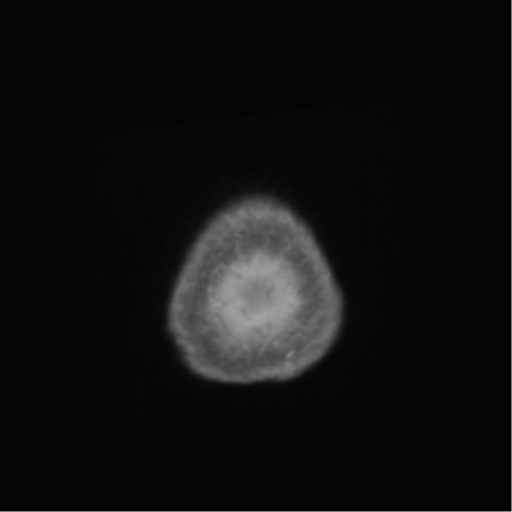 Anaplastic astrocytoma IDH wild-type (pseudoprogression) (Radiopaedia 42209-45278 Axial T1 C+ 155).png