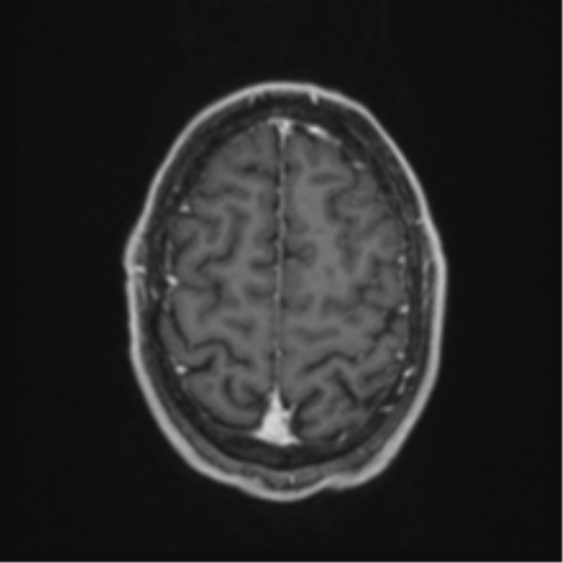 Anaplastic oligodendroglioma with skull fracture (Radiopaedia 74831-85845 Axial T1 C+ fat sat 55).png