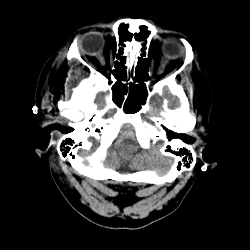 File:Aneursym related subarachnoid hemorrhage with hydrocephalus (Radiopaedia 45105-49085 Axial non-contrast 6).jpg