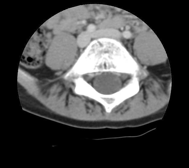 Aneurysmal bone cyst - sacrum (Radiopaedia 65190-74195 Axial non-contrast 10).jpg