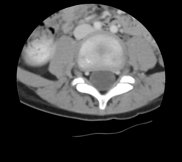 Aneurysmal bone cyst - sacrum (Radiopaedia 65190-74195 Axial non-contrast 4).jpg