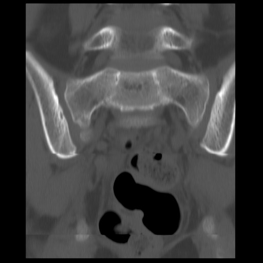 File:Aneurysmal bone cyst - sacrum (Radiopaedia 65190-74195 Coronal bone window 2).jpg