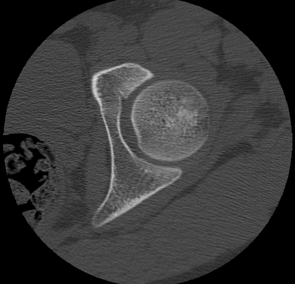 Aneurysmal bone cyst of ischium (Radiopaedia 25957-26094 B 4).png