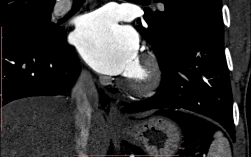 Anomalous left coronary artery from the pulmonary artery (ALCAPA) (Radiopaedia 70148-80181 B 205).jpg