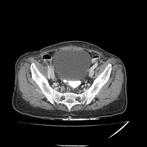 Anorectal carcinoma (Radiopaedia 44413-48064 A 45).jpg