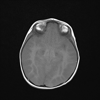 File:Anoxic brain injury (Radiopaedia 79165-92139 Axial T1 12).jpg