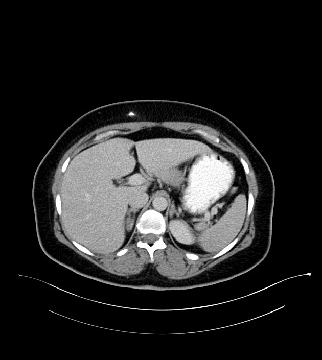 Anterior abdominal wall CSF pseudocyst (CSFoma) (Radiopaedia 79453-92571 A 27).jpg