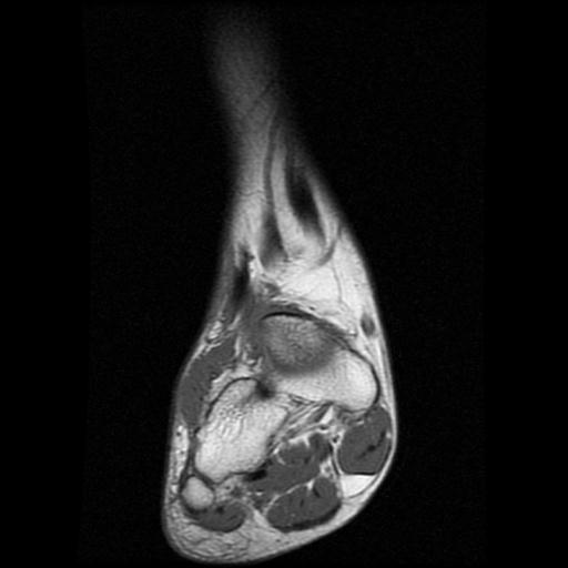 File:Anterior calcaneal process fracture (Radiopaedia 71377-81705 Coronal T1 2).jpg