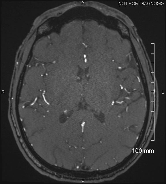 Anterior cerebral artery aneurysm (Radiopaedia 80683-94127 Axial MRA 138).jpg