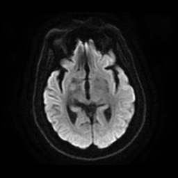 File:Anterior cerebral artery infarction (Radiopaedia 46794-51323 Axial DWI 14).jpg