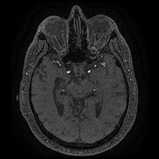 Anterior cerebral artery infarction (Radiopaedia 46794-51323 Axial MRA 85).jpg