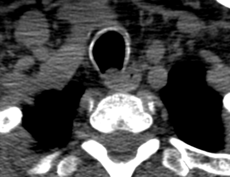 Anterior cervical postdiscectomy arthrodesis (Radiopaedia 32678-33646 Axial non-contrast 70).jpg