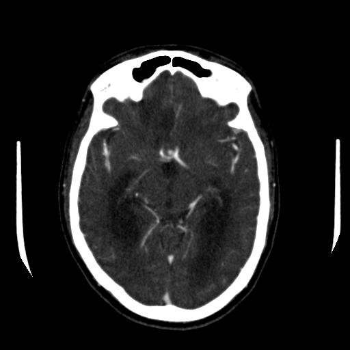 File:Anterior communicating artery aneurysm (Radiopaedia 16633-16335 A 19).jpg