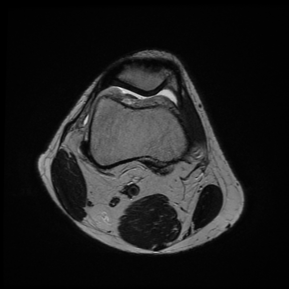 File:Anterior cruciate ligament graft tear and bucket-handle tear of medial meniscus (Radiopaedia 75867-87254 Axial T2 22).jpg