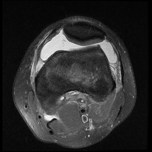 File:Anterior cruciate ligament tear (Radiopaedia 61500-69462 Axial PD fat sat 6).jpg