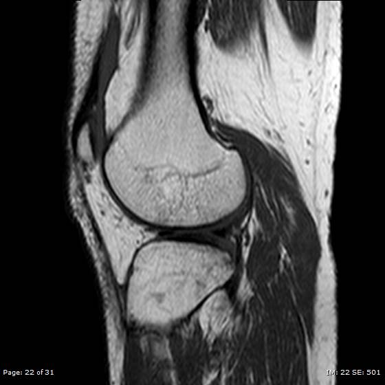 File:Anterior cruciate ligament tear (Radiopaedia 70783-80964 Sagittal T1 22).jpg