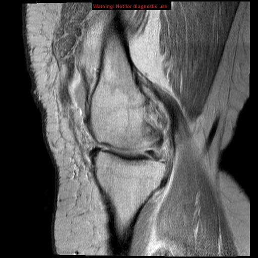 File:Anterior cruciate ligament tear - complete (Radiopaedia 12175-12514 Sagittal PD 14).jpg