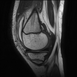 Anterior cruciate ligament tear - pediatric (Radiopaedia 62152-70260 Sagittal PD 48).jpg
