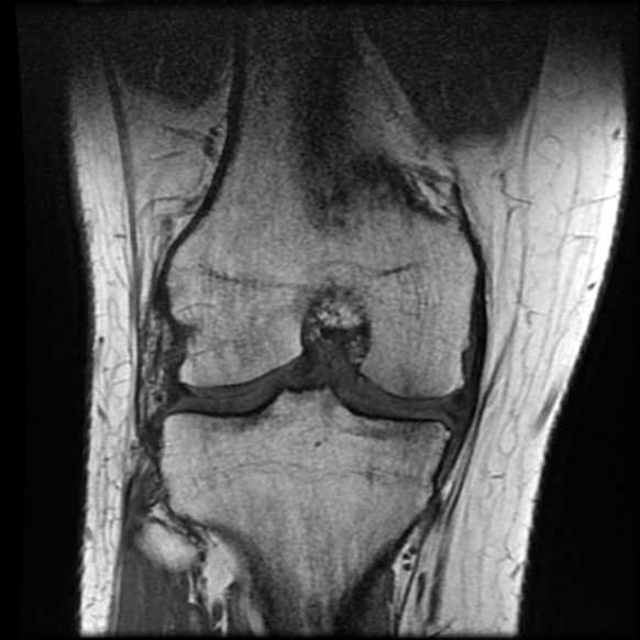 File:Anterior cruciate ligament tear with posteromedial corner injury, bucket-handle meniscal tear and chondral delamination (Radiopaedia 75501-86744 Coronal T1 16).jpg