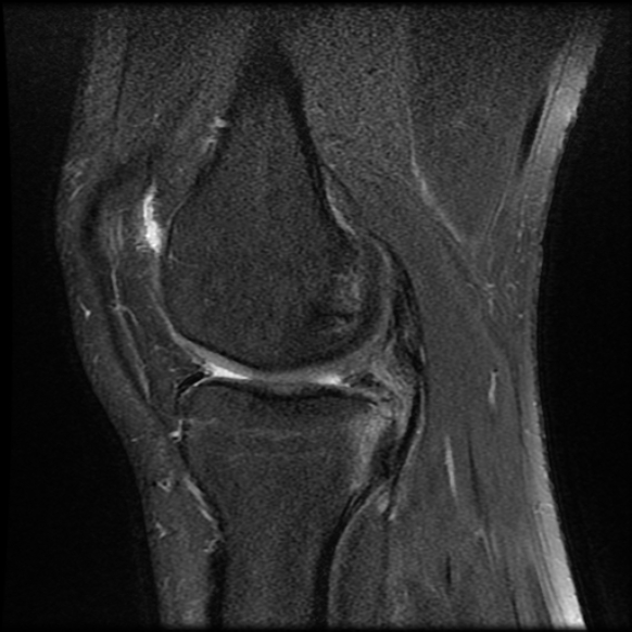 File:Anterior cruciate ligament tear with posteromedial corner injury, bucket-handle meniscal tear and chondral delamination (Radiopaedia 75501-86744 Sagittal PD fat sat 10).jpg