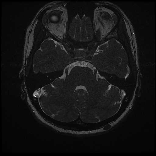 Anterior inferior cerebellar artery vascular loop - type II (Radiopaedia 70991-81209 Axial 3D FIESTA 19).jpg