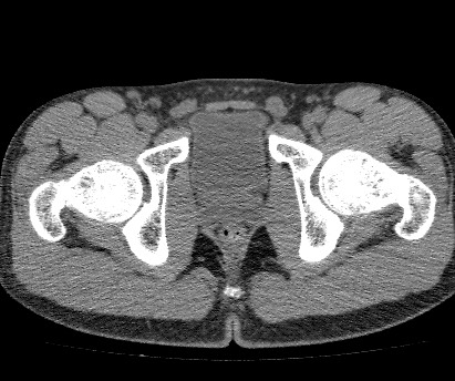 Anterior inferior iliac spine avulsion fracture (Radiopaedia 81312-94999 Axial non-contrast 59).jpg