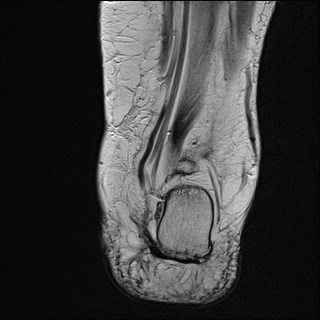 File:Anterior talofibular ligament injury - rupture with soft-tissue impingement (Radiopaedia 38765-40928 Coronal T2 8).jpg
