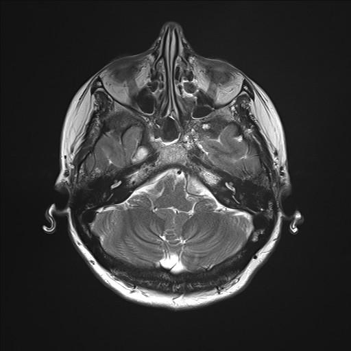 File:Anterior temporal encephalocele (Radiopaedia 82624-96808 Axial T2 7).jpg