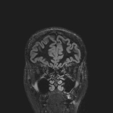 Anterior temporal encephalocele (Radiopaedia 82624-96808 Coronal FLAIR 9).jpg