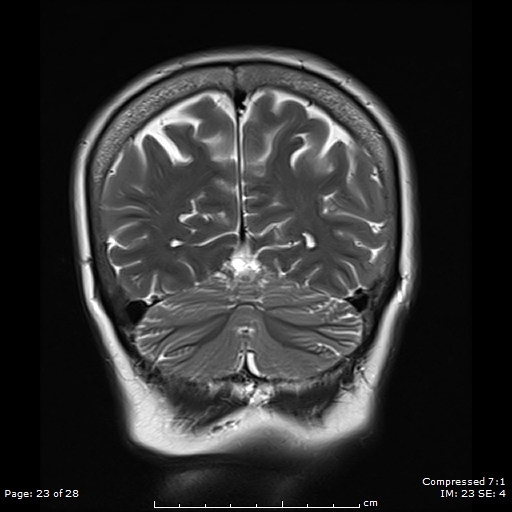 File:Anterior temporal lobe perivascular space (Radiopaedia 88283-104914 Coronal T2 23).jpg